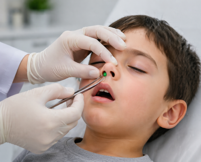 Foreign Bodies in the Nose