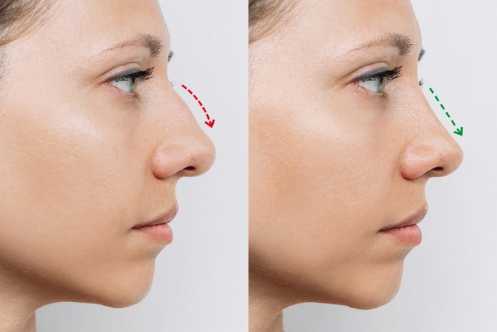 Plastic Surgery of the Nose (Rhinoplasty)