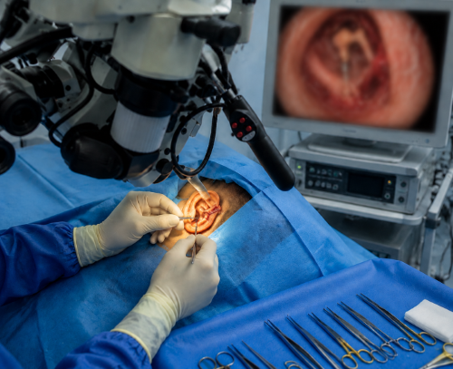 Tympanoplasty (Ossiculoplasty) 
